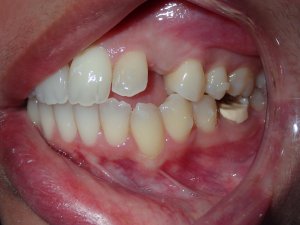 Close-up photograph of a persons teeth before getting dental implants.