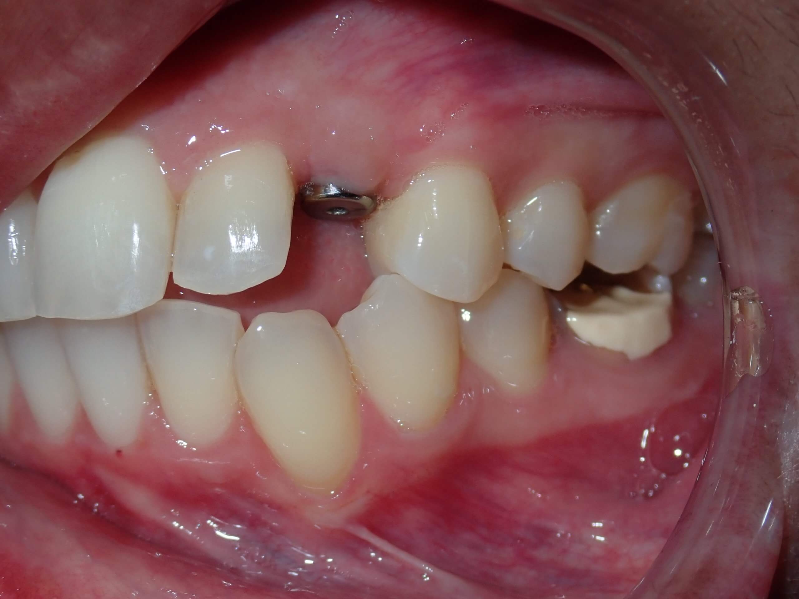 before dental implants 2