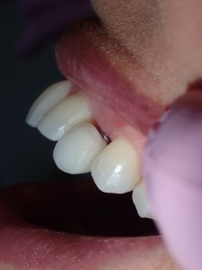 Close-up photograph of a persons teeth after getting dental implants.