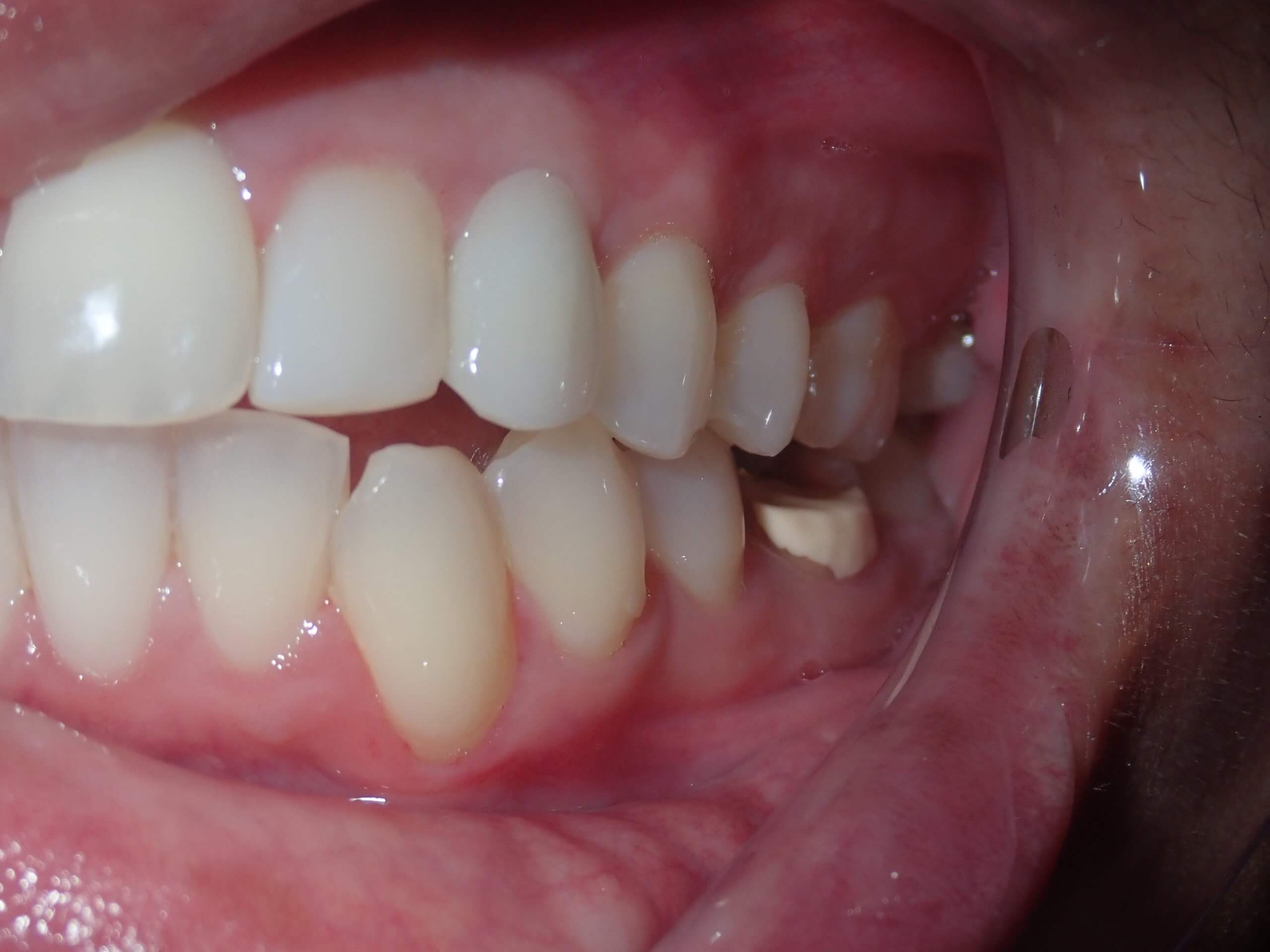 after dental implants 3