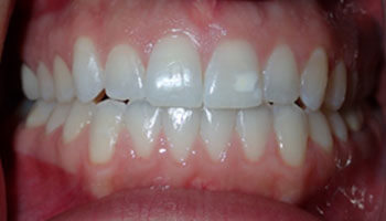 Teeth Whitening in Lodi Near Maywood