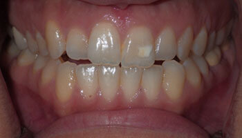 Teeth Whitening in Lodi Near Maywood