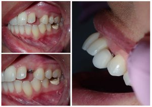 collage of three pictures showing dental implant procedure