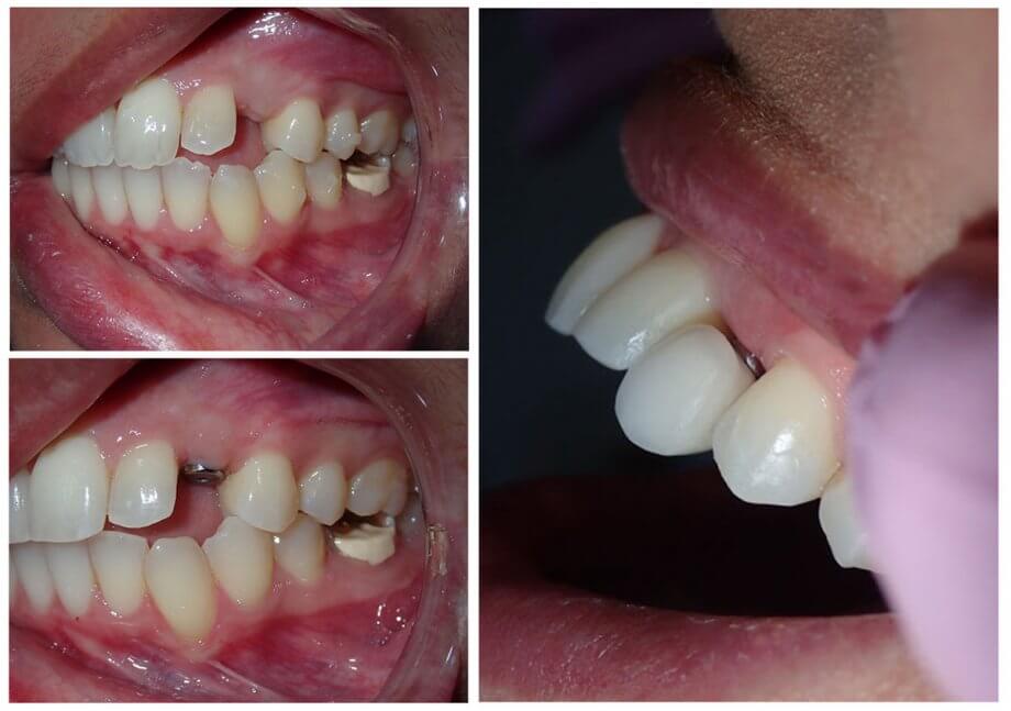 Dental implants Kent