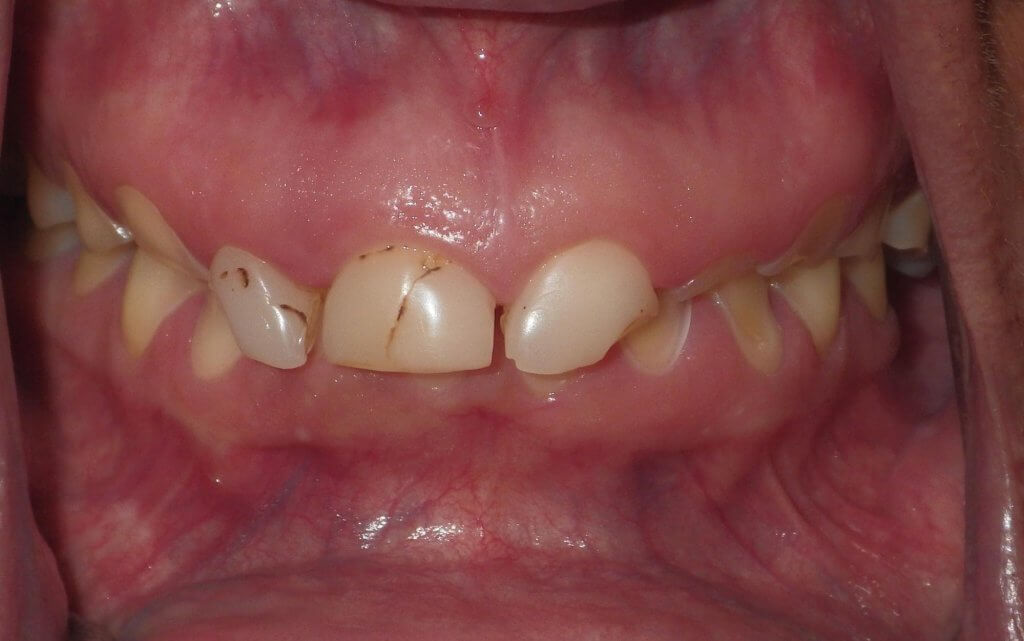 before dental implants 1
