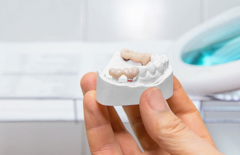 Dental Implant Alternatives