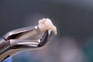 Wisdom Teeth Extractions in Lodi, NJ