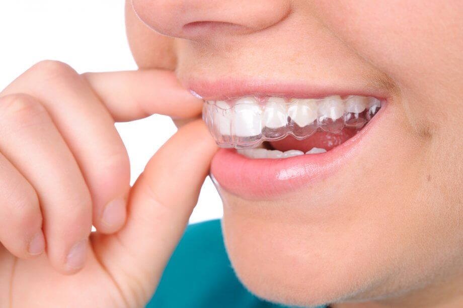 What to Look For When "Shopping" for Invisalign